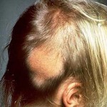 алопеция ареата